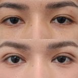 Before and after droopy eyelid surgery results at Wansiri Hospital, improved eyelid appearance