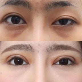 Before and after droopy eyelid surgery results at Wansiri Hospital, improved eyelid appearance