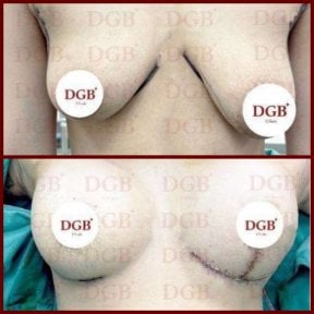 Resultados antes y después de mastopexia en DGB Clinic: mejor forma y contorno mamario