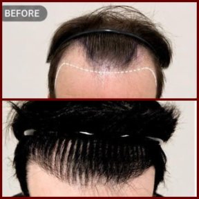 before-after photo hair-transplant