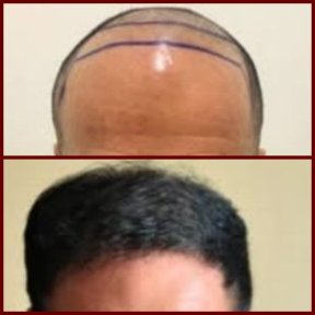 before-after photo hair-transplant
