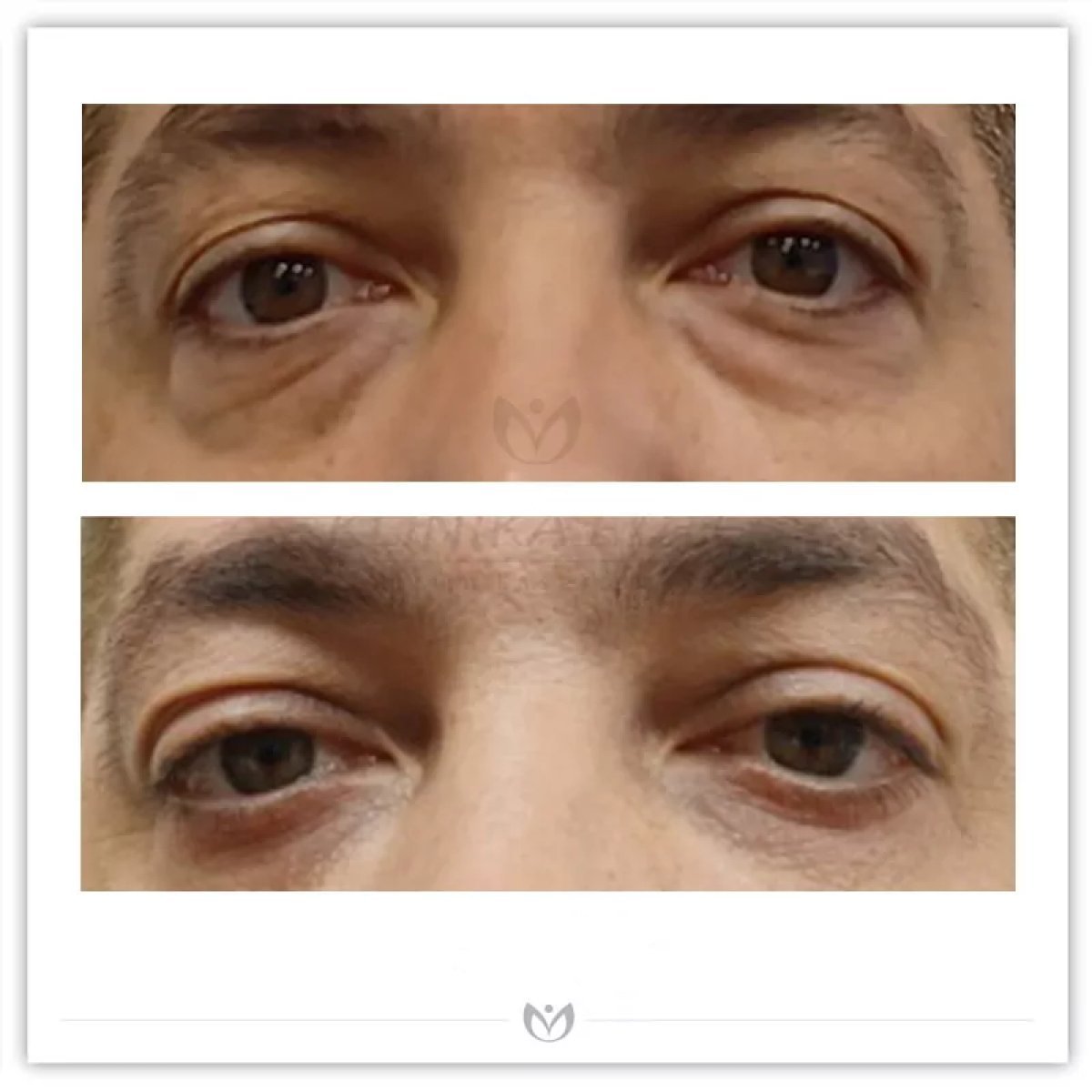 Resultados de blefaroplastia antes y después en Klinika Elite Centrum Laseroterapii, corrección de párpados