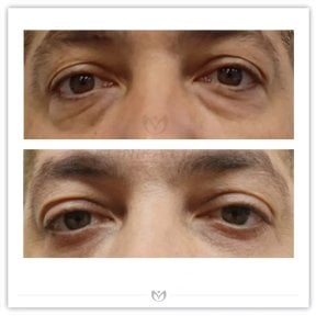 Before and after blepharoplasty results at Klinika Elite Centrum Laseroterapii, eyelid correction