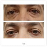 Before and after blepharoplasty results at Klinika Elite Centrum Laseroterapii, eyelid correction