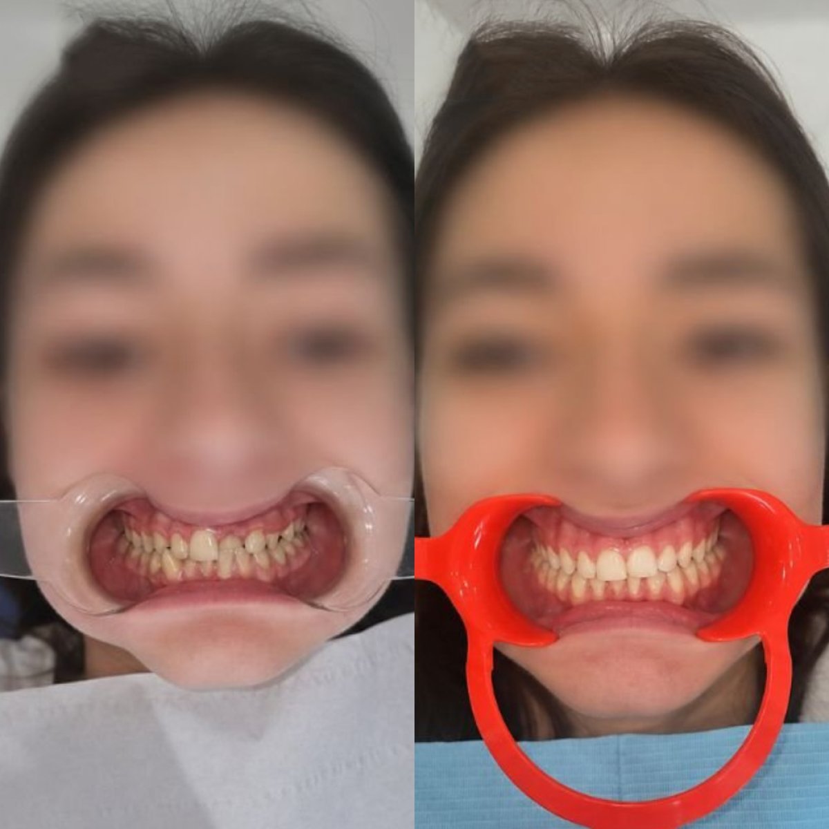 Resultados antes y después de ortodoncia en Unident Clinic: alineación dental mejorada
