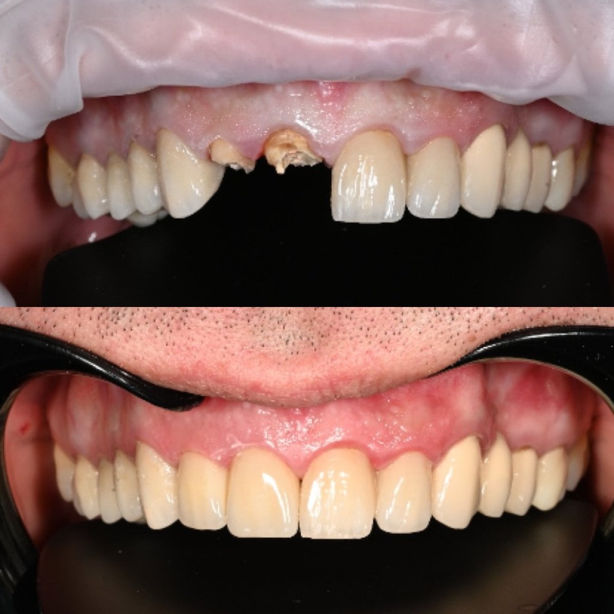 قبل وبعد تركيب تيجان الزركونيا في عيادة Unident – نتيجة ابتسامة مستعادة