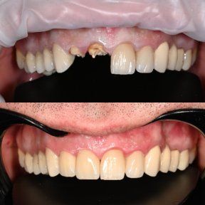 before-after photo zirconia-crown-installation