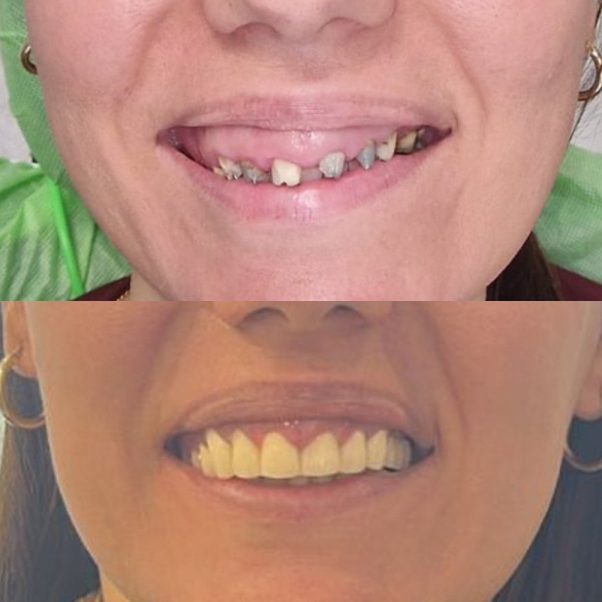 Resultados de gingivectomía antes y después en Unident Clinic – mejora de encías y sonrisa