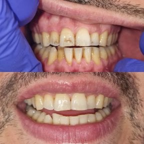 before-after photo teeth-cleaning