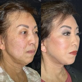 before-after photo deep-plane-facelift