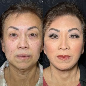 before-after photo deep-plane-facelift