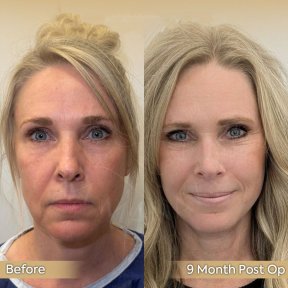 before-after photo deep-plane-facelift