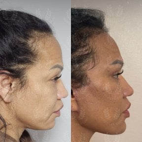 before-after photo deep-plane-facelift