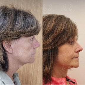 before-after photo deep-plane-facelift