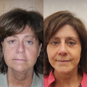 before-after photo deep-plane-facelift