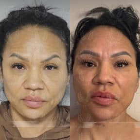 before-after photo tightening-of-facial-skin-facelift