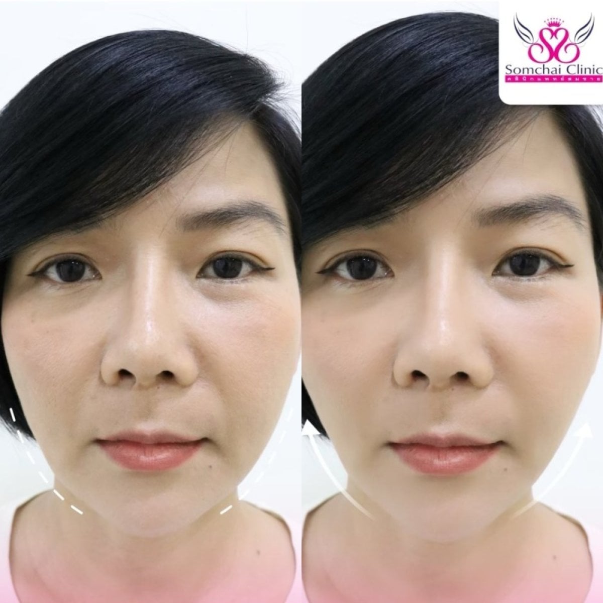 Resultados antes y después de lifting facial sin cirugía en Somchai Clinic, contorno visible
