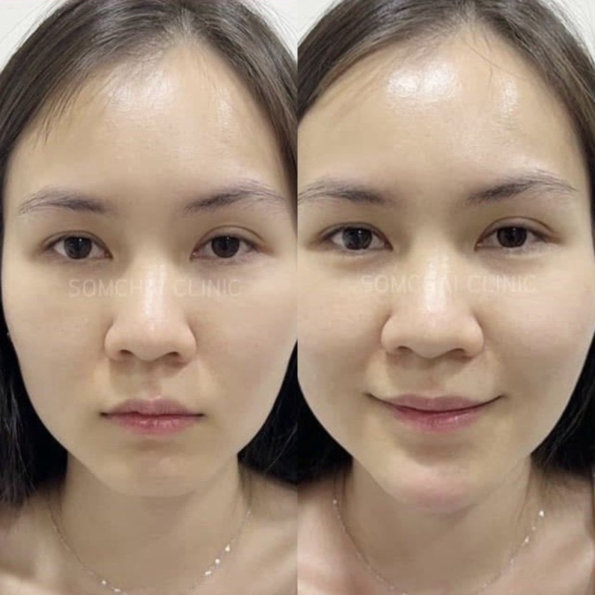 Resultados antes y después de lifting de cejas en Somchai Clinic, elevación visible
