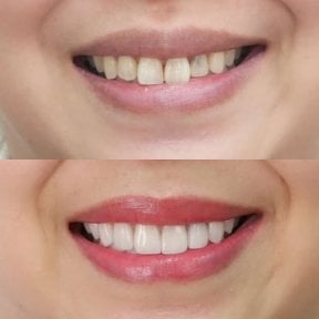 Before and after veneers at Dentist at home, Bangkok – smile makeover with natural results