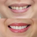 Before and after veneers at Dentist at home, Bangkok – smile makeover with natural results