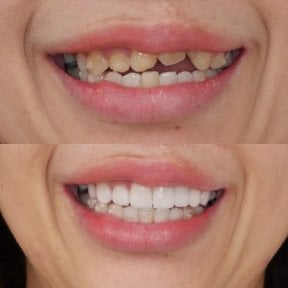 Before and after veneers at Dentist at home, Bangkok – smile makeover with natural results