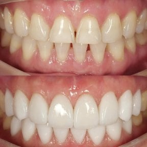 Before and after veneers at Dentist at home, Bangkok – smile makeover with natural results