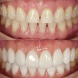 Before and after veneers at Dentist at home, Bangkok – smile makeover with natural results