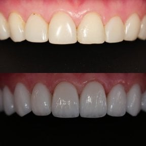 Before and after veneers at Dentist at home, Bangkok – improved smile and whiter teeth result