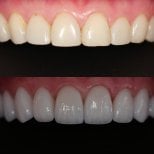 Before and after veneers at Dentist at home, Bangkok – improved smile and whiter teeth result