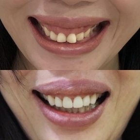 Before and after veneers at Dentist at home, Bangkok – smile makeover visible result