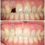 Before and after dental implant results at Dentist at home, Bangkok – restored front tooth