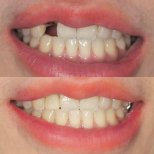 Resultados antes y después de implante dental en Dentist at home, Bangkok – diente restaurado
