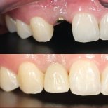 Resultados antes y después de implante dental en Dentist at home, Bangkok – restauración de dientes frontales