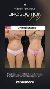 before-after photo arms-plastics-brachioplasty