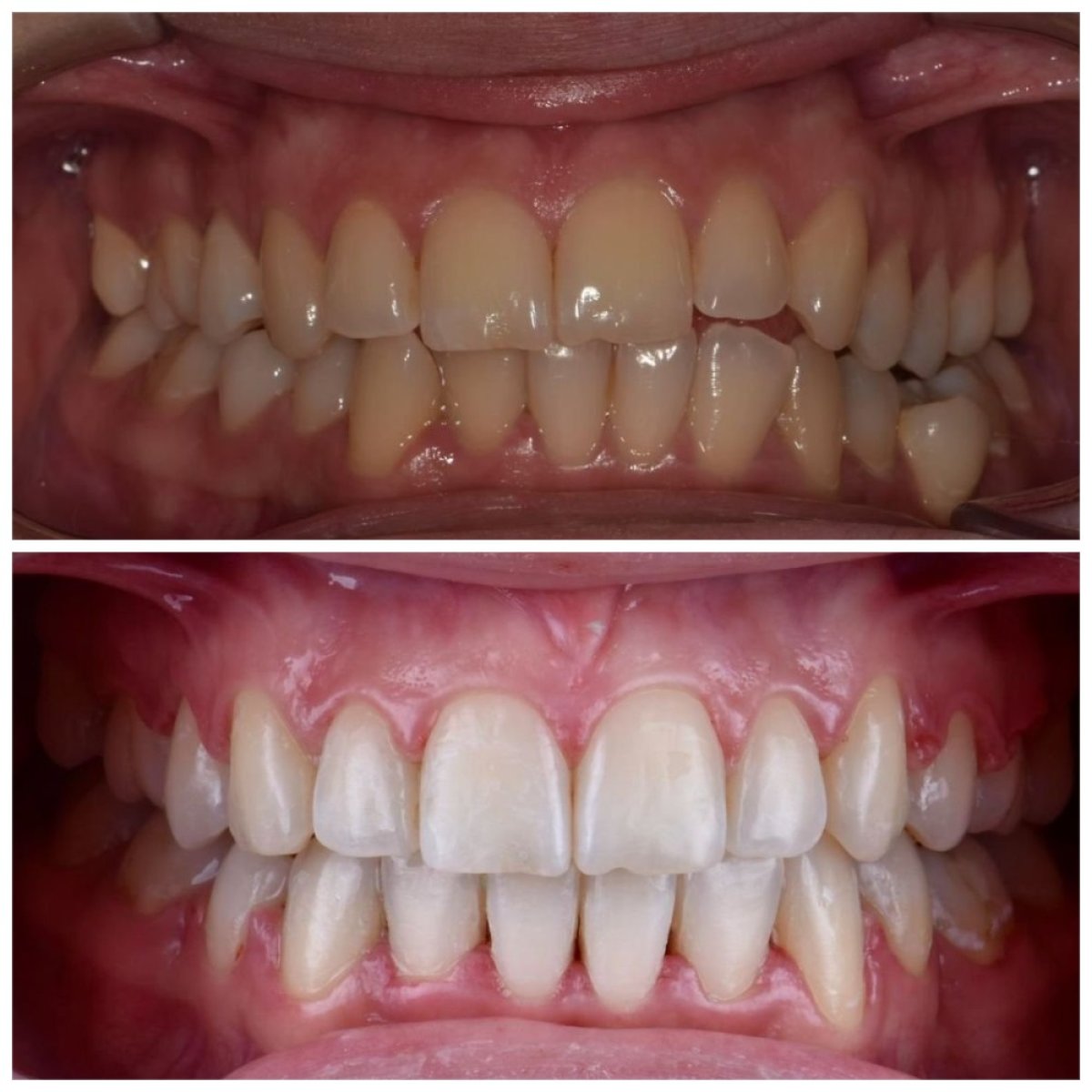 Resultados antes y después de alineadores transparentes en Smile Centrum: mejor alineación dental