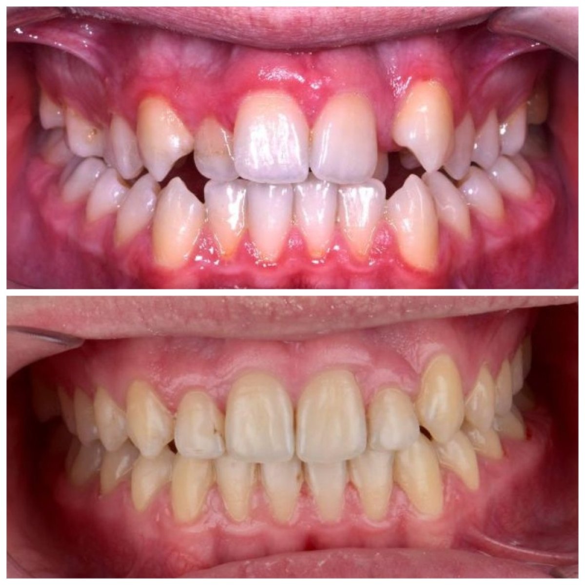 Antes y después de alineadores transparentes en Smile Centrum: alineación dental y corrección de mordida