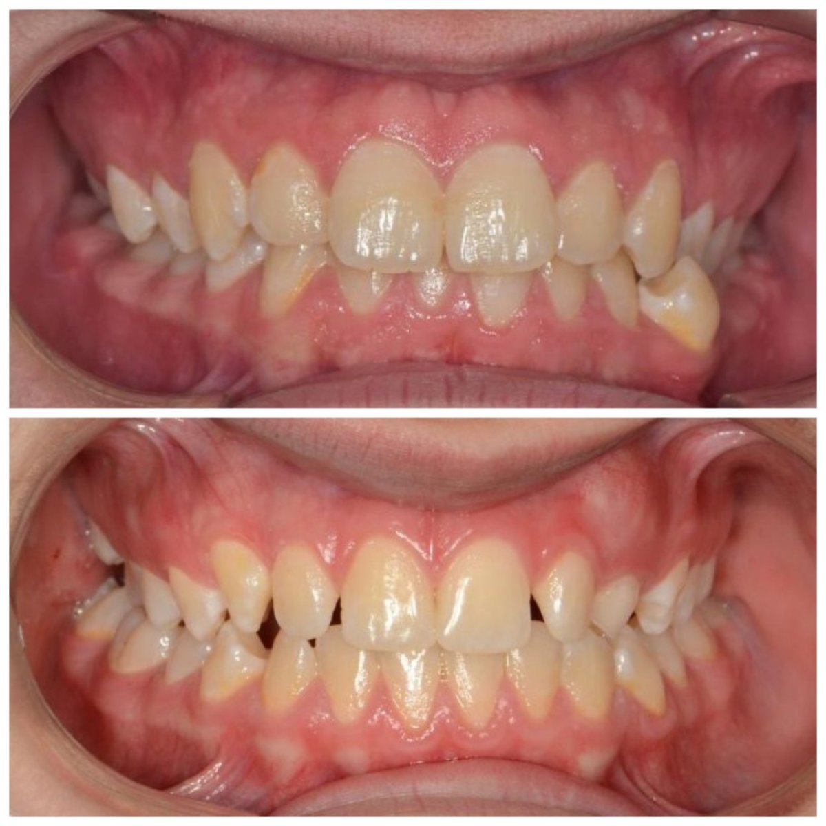 Resultados antes y después de alineadores transparentes en Smile Centrum: dientes más rectos