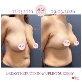 before-after photo breast-reduction