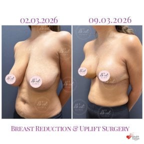 before-after photo breast-reduction