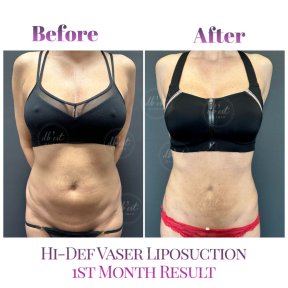 before-after photo gynecomastia-surgery