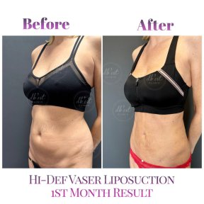 before-after photo gynecomastia-surgery