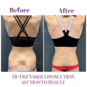 before-after photo gynecomastia-surgery