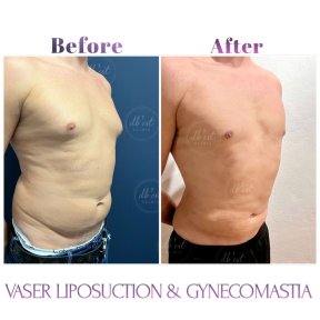 before-after photo gynecomastia-surgery