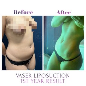 before-after photo gynecomastia-surgery