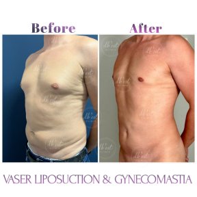 before-after photo gynecomastia-surgery