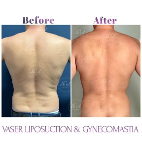 before-after photo gynecomastia-surgery