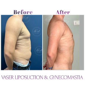 before-after photo gynecomastia-surgery
