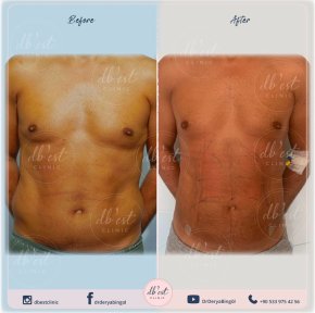 before-after photo gynecomastia-surgery