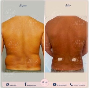 before-after photo gynecomastia-surgery