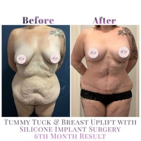 before-after photo body-lift